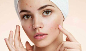 যে ভাবে ব্রণ কমাবেন