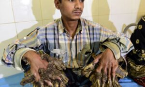 ফের ‘শেকড়’ গজিয়েছে বৃক্ষমানব আবুল বাজানদারের